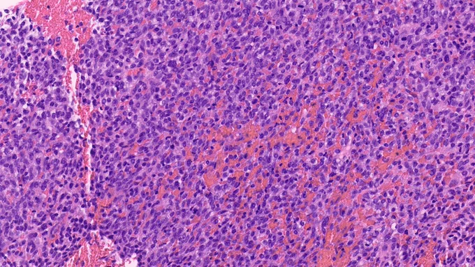 Sheets of "round blue cells" in a solitary fibrous tumor