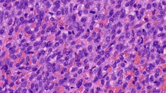 Tumor cells in this SFT showed cytoplasmic vacuolizatoin. 