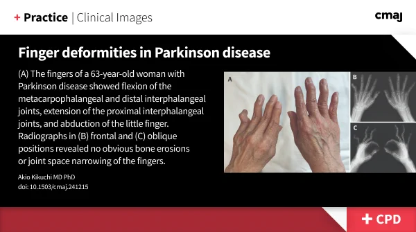 (A) The fingers of a 63-year-old woman with Parkinson disease showed flexion of the metacarpophalangeal and distal interphalangeal joints, extension of the proximal interphalangeal joints, and abduction of the little finger. Radiographs in (B) frontal and (C) oblique positions revealed no obvious bone erosions or joint space narrowing of the fingers.