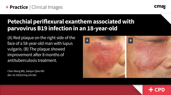 (A) Red plaque on the right side of the face of a 58-year-old man with lupus vulgaris. (B) The plaque showed improvement after 8 months of antituberculosis treatment.