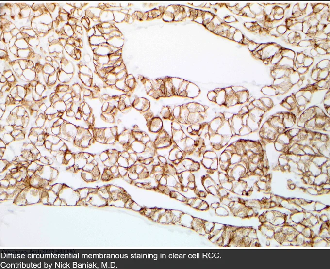 Figures 1 and 3: Pathology Outlines
Figure 2: Courcier et al. Carbonic Anhydrase IX in Renal Cell Carcinoma, Implications for Disease Management. International Journal of Molecular Sciences. 2020; 21(19):7146.