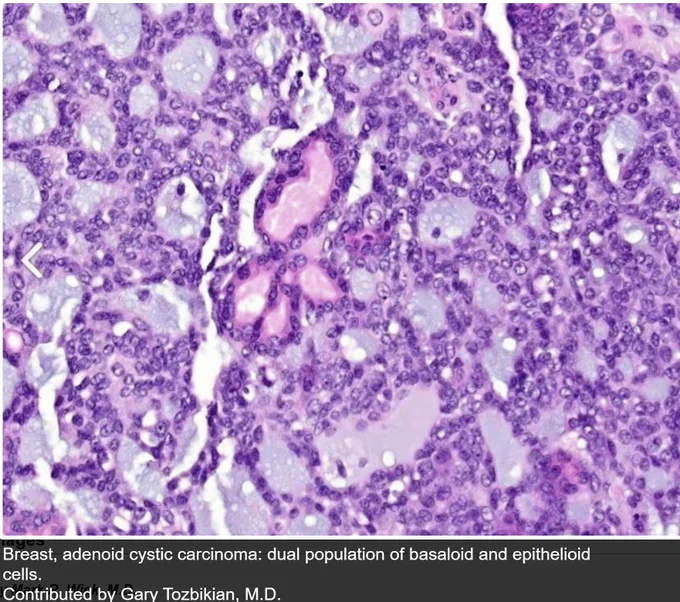 Credit: Pathology Outlines and
Puri S, Mohindroo S, Gulati A. Collagenous spherulosis: An interesting cytological finding in breast lesion. Cytojournal. 2015;12:25. Published 2015 Nov 30.