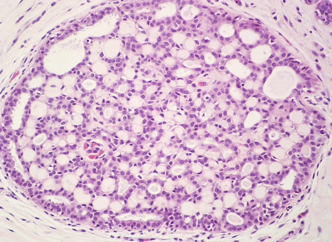 Credit: Iskender Sinan Genco, M.D. and Sabina Hajiyeva, M.D. (Pathology Outlines)