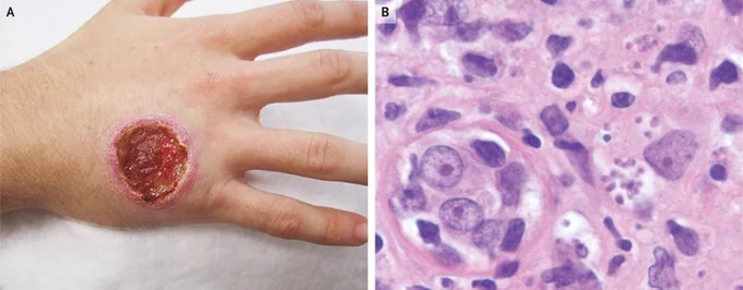 Cutaneous Leishmaniasis, Alexia Knapp, MD, Jonathan Alpern, MD https://www.nejm.org/doi/10.1056/NEJMicm1908092