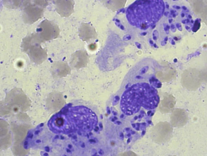 Joachim Richter https://www.researchgate.net/figure/Leishmania-amastigotes-Giemsa-stain-in-a-smear-of-the-buccal-mucosa-patient-1_fig3_51057580  