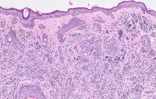 Credit: pathology outlines, Yuri Tachibana, MD and Carlos Torres-Cabala, MD