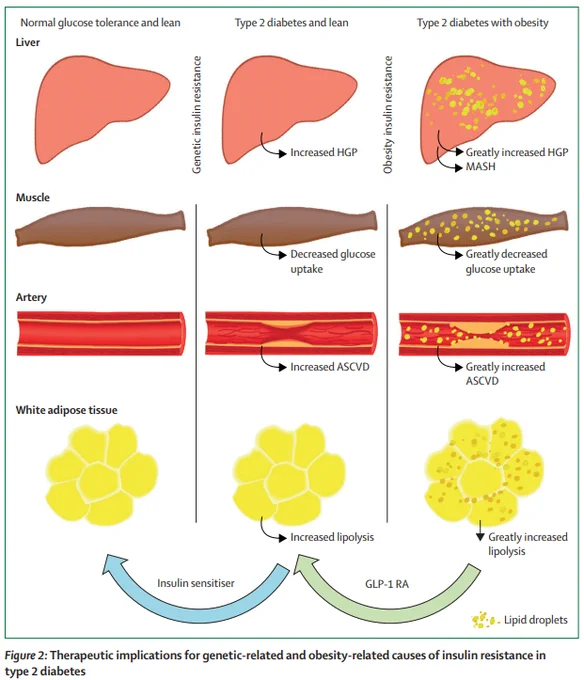 Type 2 diabetes is characterised by insulin resistance involving multiple tissues including liver, kidney, skeletal and cardiac muscle, vasculature, adipose tissue, and β cells. The insulin resistance is genetic in origin and can be shown early in life in lean, glucose-tolerant individuals, long before the onset of overt diabetes. Excess caloric intake exacerbates the underlying genetic cause of the insulin resistance, placing stress on the β cells, which themselves are genetically predisposed to dysfunction. GLP-1 receptor agonists can reverse the component of insulin resistance that is related to obesity and lipotoxicity, but cannot correct the genetic component of insulin resistance, which only can be reversed by insulin-sensitising drugs that address the basic genetic or molecular causes of insulin resistance. HGP=hepatic glucose production. ASCVD=atherosclerotic cardiovascular disease. GLP-1 RA=glucagon-like peptide-1 receptor agonist. 