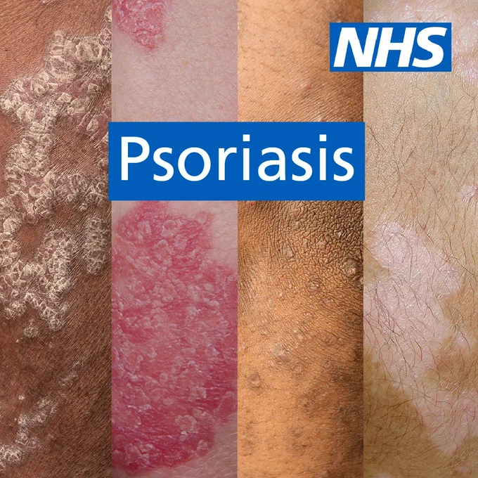 Four different skin tones are shown all displaying psoriasis. It shows that psoriasis can display differently for different people. The NHS logo is in the top corner.