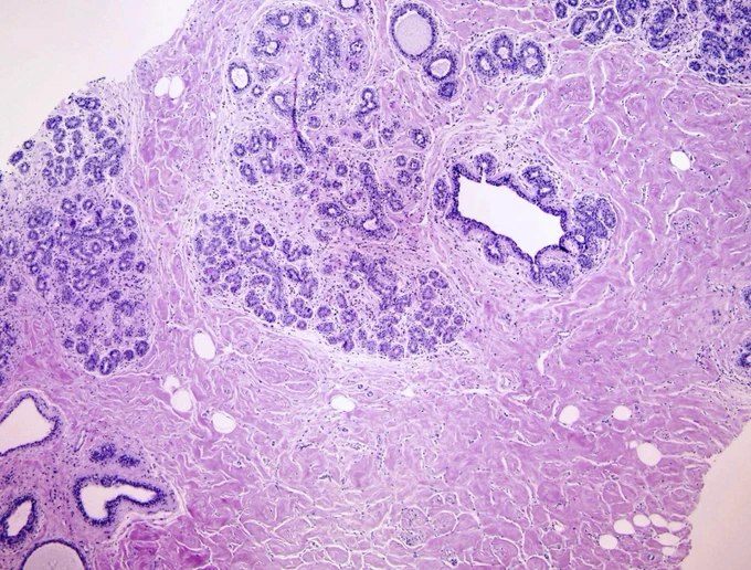 Credit: Indu Agarwal, MD (Pathology Outlines)