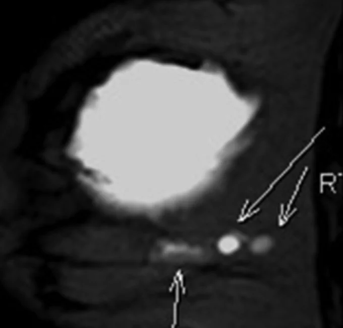 1) Indian J Radiol Imaging. 2016 Apr-Jun;26(2):216–225. doi: 10.4103/0971-3026.184409
2) Julie M. Jorns, M.D. (Pathology Outlines)