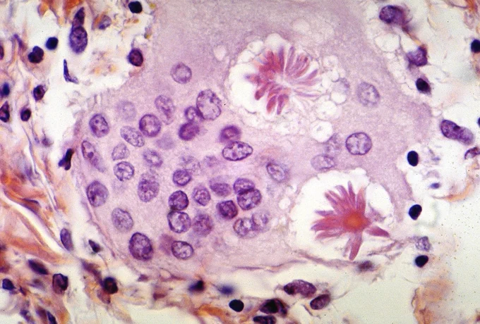 Dr. Yale Rosen Atlas of Pulmonary Pathology (Flickr)