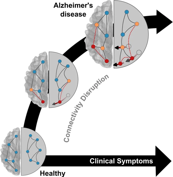 A diagram of brain network disruptions in Alzheimer's disease. The diagram shows a progression from a healthy brain, in the bottom left, to an Alzheimer's-affected brain, in the top right, along an axis labeled 'Clinical Symptoms.' Each brain illustration contains a network of connected nodes, with increasing disruption and altered connections — shown as red dashed lines — as the disease progresses. The middle section highlights growing connectivity disruptions, leading to significant changes in brain networks.