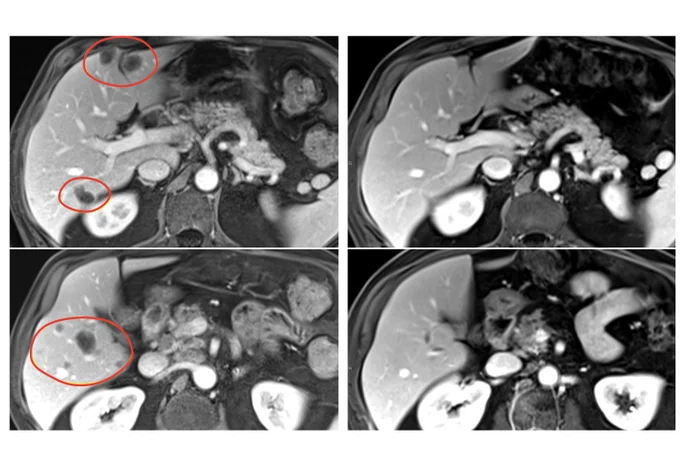 Image of an MRI scan showing shrinkage of multiple liver metastases from a patient with rectal cancer. 