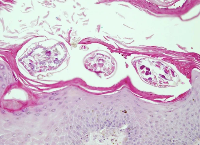 Photo credits: Eric W. Hossler, M.D. (Pathology Outlines)