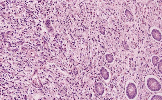 Photo Credits: Bella Lingjia Liu, M.D. (Pathology Outlines)