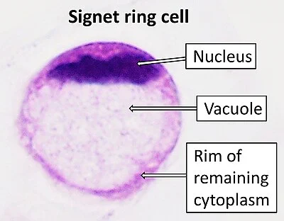 Photo Credit: Mikael Häggström, M.D. (Wiki)