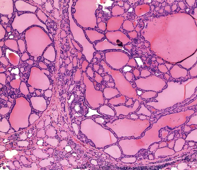 DICER1 syndrome and thyroid disease. Michael Canfarotta et al. Journal of Pediatric Surgery Case Reports 11(C). June 2016. DOI:10.1016/j.epsc.2016.05.014