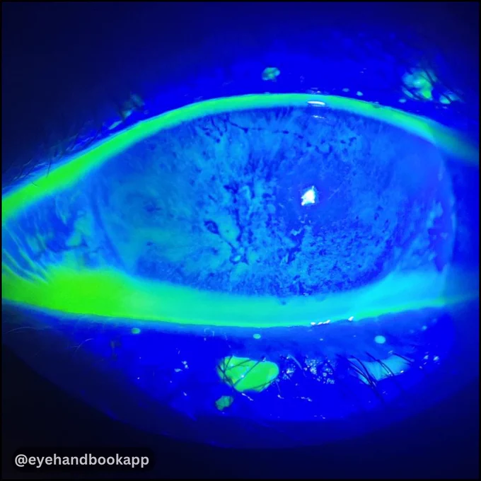 When you see a case of stromal edema with no cellularity in AC and an epithelium that looks like this with a relatively quiet eye. How do you differentiate between a stromal Keratitis vs PBK?

Make your work easier with the #free Eye Handbook mobile app! Get instant access to calculators, forums, clinical references, and expert discussions—right from your smartphone or tablet.

💬 Join the conversation: Share your insights on the Eye Handbook forum!
🔗 View & respond here:
https://www.eyehandbook.com/eyehandbook-beta/ehb_digest_post_dotnet.php?que_id=1966

📲 Download the Eye Handbook App (Android & iOS):
🔗 Click here: https://onelink.to/eyehandbookapp