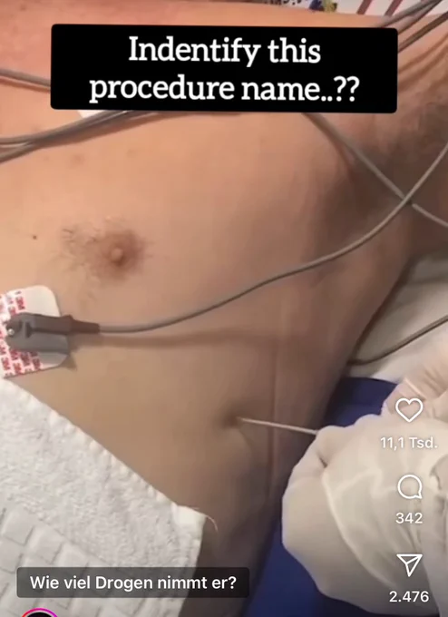 Thorax Punktion mit einer Nadel in der vorderen axillarlinie, mehrere cm unter der mamille