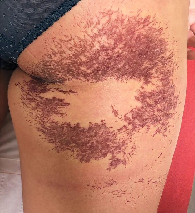 A photo of innumerable fine, erythematous, linear lesions in a stellate distribution with central clearing  seen on the posterior right thigh 