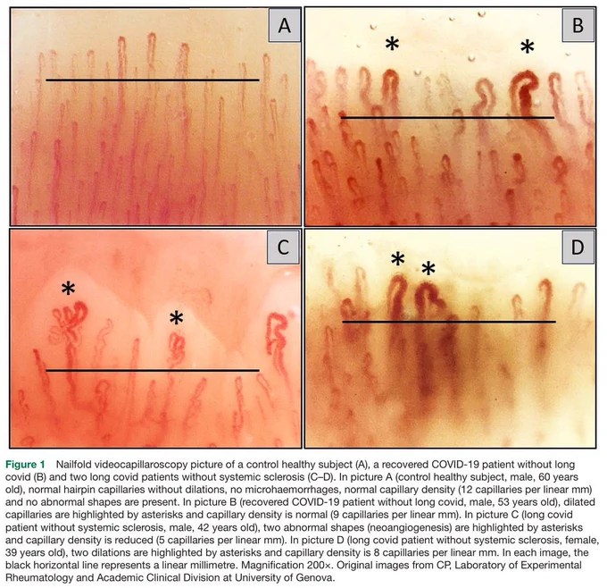 Alt text:
A set of four microscopic images (labelled A–D) shows capillaries under the fingernails of four different people, captured using nailfold videocapillaroscopy at 200× magnification. Each image includes a black horizontal line representing one millimetre of skin.

Image A (top left): A healthy control subject with neatly arranged, uniform, hairpin-shaped capillaries. Capillary density is high (12 per mm), with no abnormalities.

Image B (top right): A person who recovered from COVID-19 without Long Covid. Capillaries appear mostly normal, but two are visibly dilated (marked with asterisks). Density is slightly reduced (9 per mm).

Image C (bottom left): A person with Long Covid. Capillaries are fewer and more irregular (5 per mm), with two showing abnormal twisted shapes (neoangiogenesis), marked by asterisks.

Image D (bottom right): Another Long Covid patient. Capillaries appear darker, some are dilated (marked by two asterisks), and the density is moderately reduced (8 per m