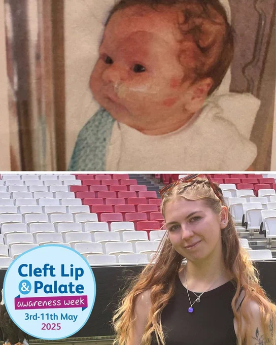 Collage of two photos. First shows close up of newborn with a nasogastric tube. The second image shows a close up of a young woman with stadium seats showing behind her.