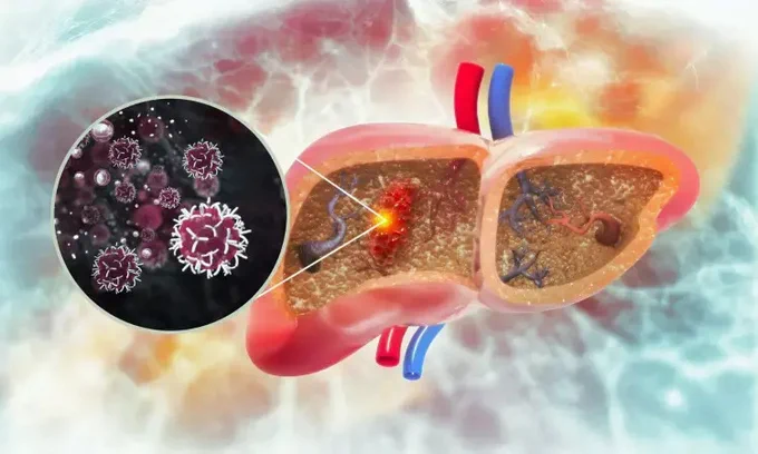 Image source: https://medicaldialogues.in/h-upload/2024/04/05/750x450_235652-transarterial-chemoembolization.webp
