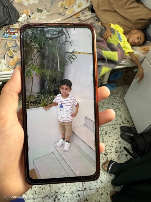 A child who is now severely malnourished is lying on a hospital bed while a photo of him when he was healthy is shown on a phone 