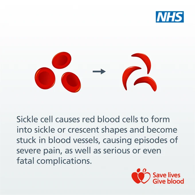 Graphic showing normal round red blood cells changing into sickle-shaped cells, with NHS and 'Save lives Give blood' logos. Text explains that sickle cell causes red blood cells to form abnormal shapes, blocking blood vessels and causing severe pain or complications.