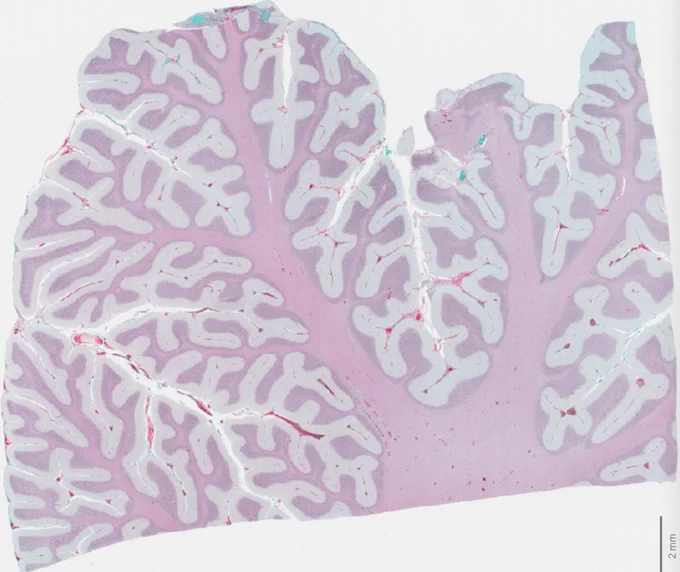 This image of a paediatric brain shows collagen (in green), which is a key part of the ECM, with healthy brain (in pink and purple). Researchers hope that targeting components like this that surround a tumour could open new pathways for immunotherapies to better reach and attack cancers. 
 