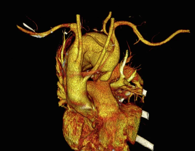 Right-sided aortic arch, aberrant left subclavian and Kommerell diverticulum.