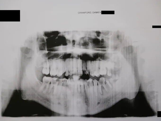 An x-ray of my teeth, with some black boxes over certain spots. Several teeth are broken and/or are very see-through.
