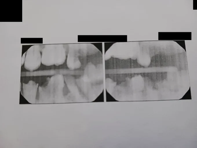 Two side-by-side targeted x-rays of a few teeth. The left has a few teeth that are recognizable as teeth. The right does not.