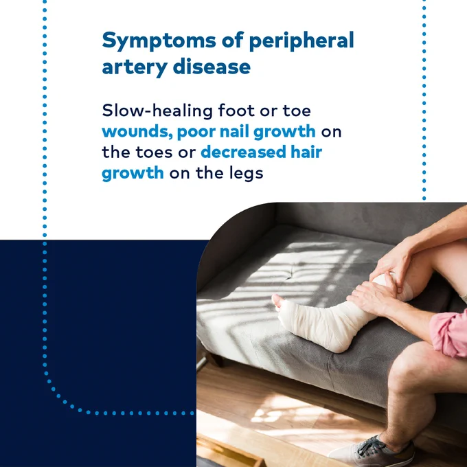 Symptoms of peripheral artery disease

Slow-healing foot or toe wounds, poor nail growth on the toes or decreased hair growth on the legs