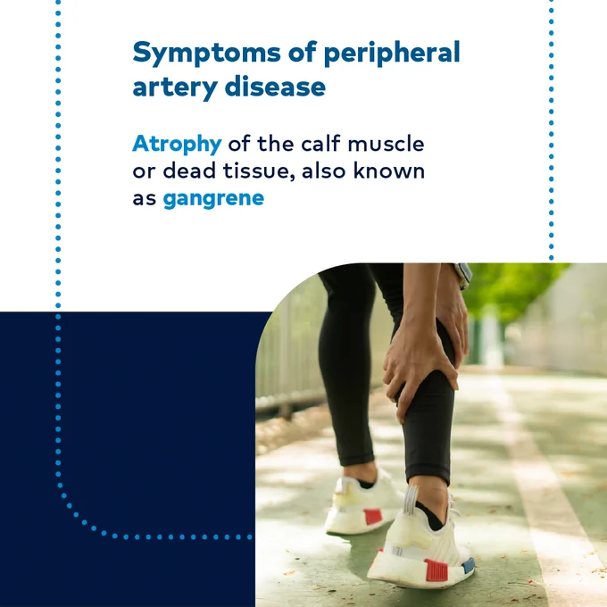 Symptoms of peripheral artery disease

Atrophy of the calf muscle or dead tissue, also known as gangrene