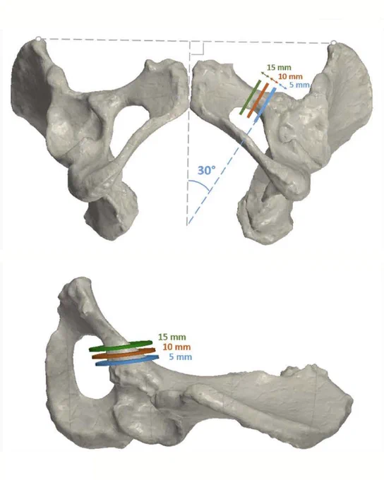 3D models of pelvic bones showing a 30-degree angle and three colored lines marking 5 mm, 10 mm, and 15 mm distances on the right side.