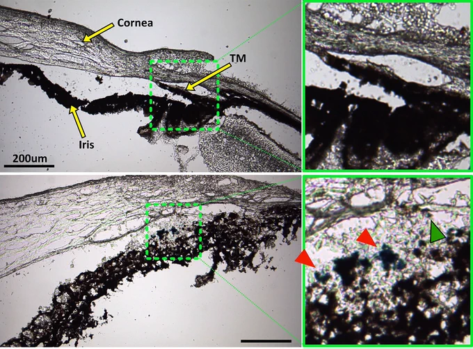 Prussian blue staining to locate superparamagnetic iron oxide nanoparticles (SPIONs) within the anterior segment after cell transplantation.Top row: No Prussian blue staining could be found in the saline injection control. Bottom row: Prussian blue stain is challenging to distinguish from melanin, but accumulation of blue label (red arrowheads) can be seen to coincide with the locations of exogenous cells visualized in Figure 6. In particular, injected human adipose-derived mesenchymal stem cells (hAMSCs) primarily accumulated close to the trabecular meshwork (TM), corresponding to the location of Prussian blue stain. A small region of Prussian blue staining can be observed in the TM (green arrowhead).