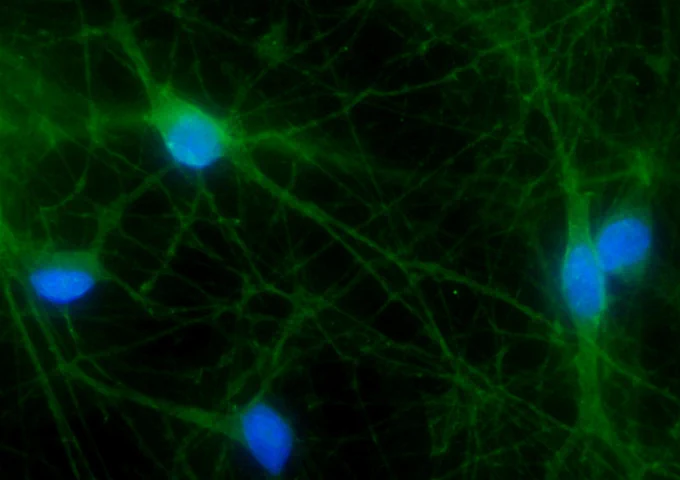 cultured human neurons, shown here under a microscope, that have a protein (green) with a mutation that causes alternating hemiplegia of childhood