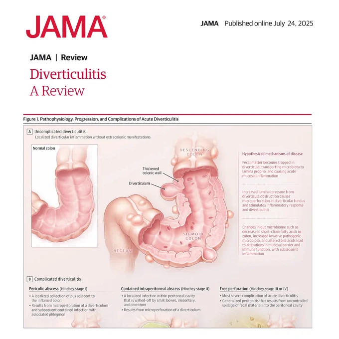 Figure 1. Pathophysiology, Progression, and Complications of Acute Diverticulitis