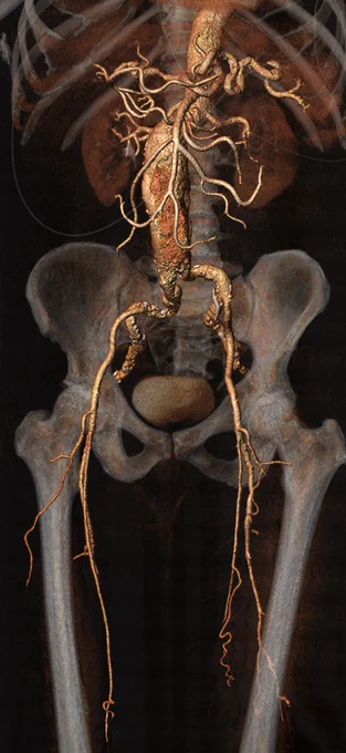 CT abdomen/pelvis and 3D reformat provided by Radiology.