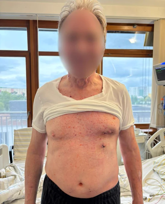 2x total arterial off-pump no-touch aorta MICS CABG