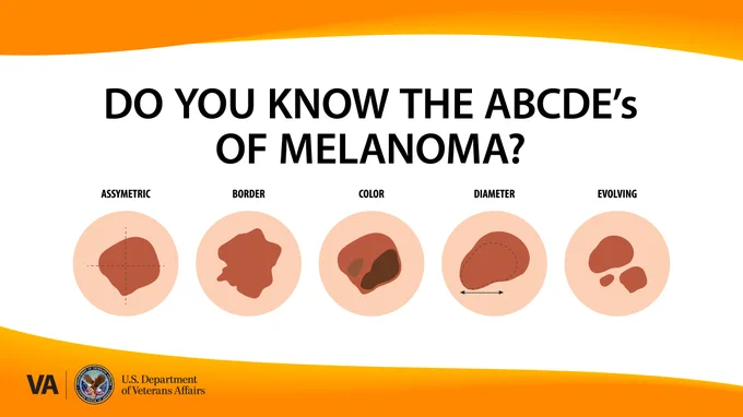 Illustration explaining melanoma detection.