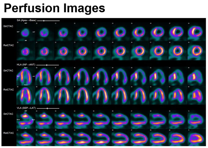 Perfusion images 