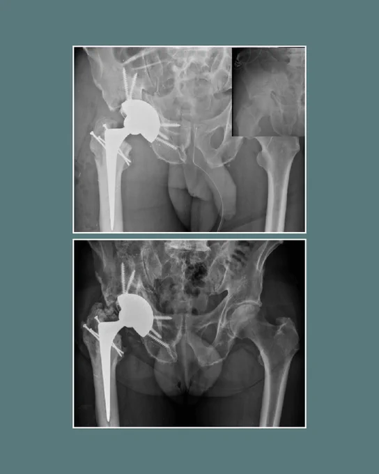Total hip arthroplasty (THA) for an acute acetabular fracture with a Trabecular Metal Revision Cup with multidirectional long intramedullary Screws (TMRCS) into the ilium, ischium, and pubis.