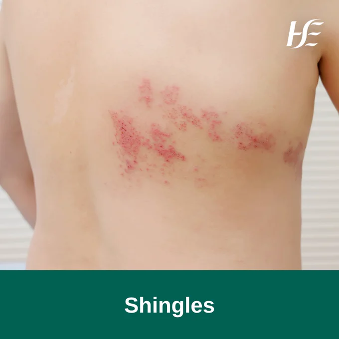 A white person's back with a red rash spread across it. The image text reads "shingles". 