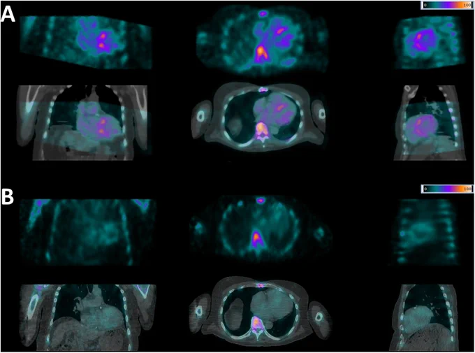 https://www.journalofnuclearcardiology.org/article/S1071-3581(25)00169-2/abstract