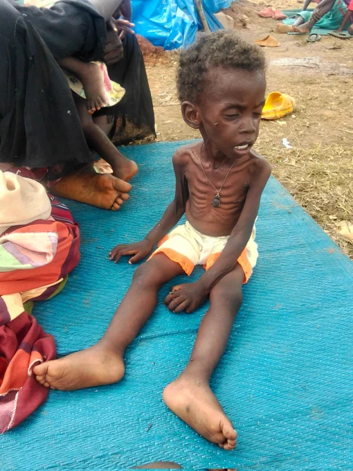 Image of Malnourished child, in Umdoreen Camp, displaced from Kadugli