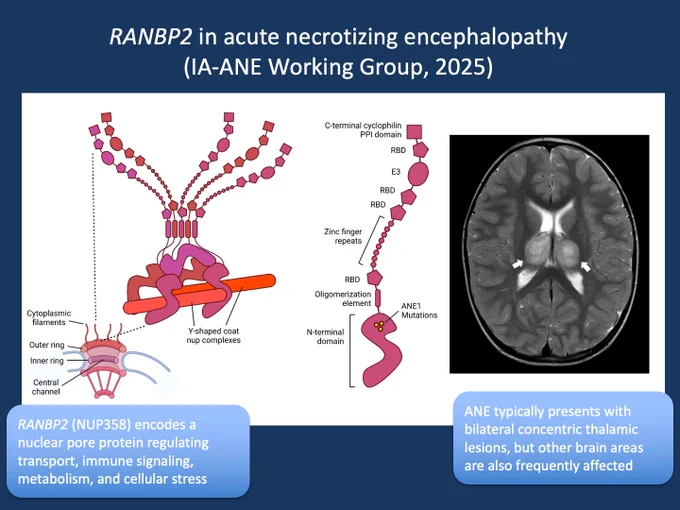 Figure 1. Function of RANBP2 and neuroimaging in ANE. Figure. Structural model of RanBP2/Nup358 and neuroimaging in acute necrotizing encephalopathy. RanBP2/Nup358 is a major component of the cytoplasmic filaments of the nuclear pore complex, which has an eightfold symmetry with each symmetrical unit referred to as a ‘spoke’. Five copies of RanBP2/Nup358 are found at each spoke, for a total of 40 copies per pore. The N-terminal domain attaches to the pore and is the spot where ANE1 mutations cluster. On the right, magnetic resonance imaging from a 3-year-old child presenting with a viral prodrome and rapid neurological decline. T2-weighted axial images demonstrate the characteristic bilateral thalamic lesions typical of acute necrotizing encephalopathy (figure adapted from Palazzo et al., 2022 under CC BY 4.0, http://creativecommons.org/licenses/by/4.0/).