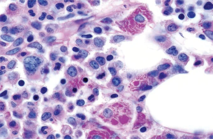 CRYSTAL-STORING HISTIOCYTOSIS:
Scattered marrow histiocytes contain abundant crystallized immunoglobulin inclusions (PAS stain).