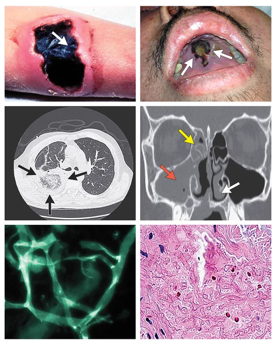 Top left: Cutaneous mucormycosis characterized by blackened, raised eschars.  
Top right: Lesions due to palatal mucormycosis.  
Middle left: In pulmonary mucormycosis, a large reversed halo sign in the right lower lobe characterized by a pulmonary infiltrate with a central ground-glass opacity that is circumscribed by denser air-space opacities.  
Middle right: Examples of imaging results in mucormycosis of the right maxillary sinus, right ethmoid sinus, and left nasal turbinates.  
Bottom left: Direct examination of sinus aspirate under fluorescence microscopy with calcofluor staining showing broad, ribbonlike hyphae with nondichotomous right-angled branching typical of rhizopus. 
Bottom right: Histopathological analysis of infected tissue with periodic acid–Schiff staining showing broad, ribbonlike hyphae with nondichotomous right-angled branching. 